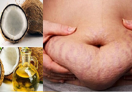  Bạn nên sử dụng dầu dừa từ khi mang thai để giảm các vết rạn trên da bụng - Ảnh minh họa: Internet