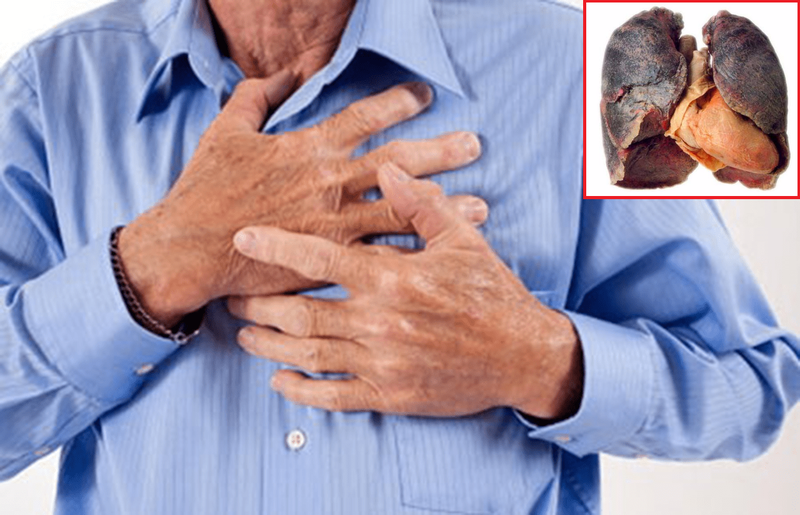  Ho, khó thở là một trong những dấu hiệu điển hình của bệnh ung thư phổi.
