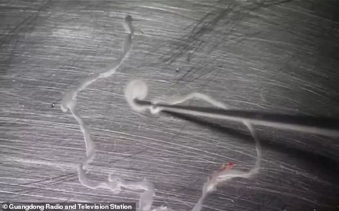  Con sán dây được lấy ra khỏi não bệnh nhân 36 tuổi ở Trung Quốc. Ảnh: ĐÀI PHÁT THANH VÀ TRUYỀN HÌNH QUẢNG ĐÔNG