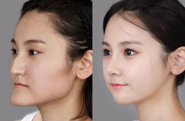  Răng bị móm trước và sau khi chỉnh sửa sẽ thay đổi cả khuôn mặt - Ảnh minh họa: Internet