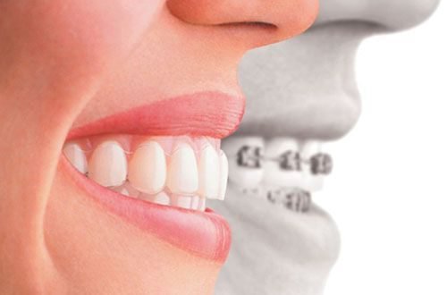  Bọc răng sứ cải thiện răng mọc lệch - Ảnh minh họa: Internet