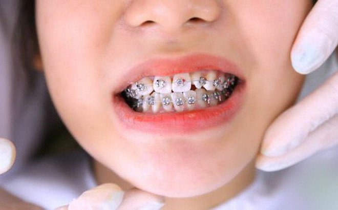  Niềng răng bằng kim loại - Ảnh minh họa: Internet
