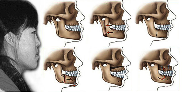  Phẫu thuật chỉnh hình ngày càng được áp dụng trong chỉnh răng - Ảnh minh họa: Internet