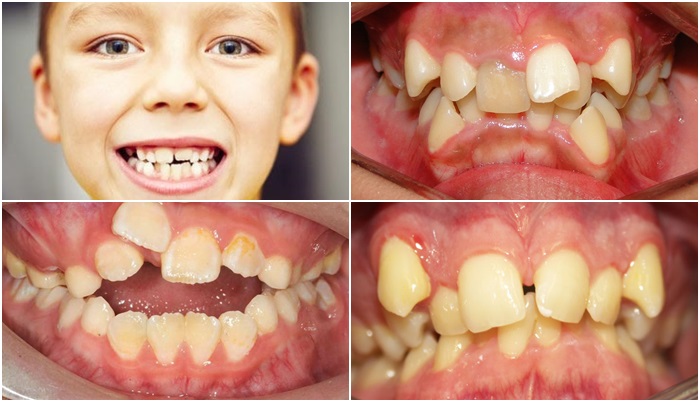  Hiện tượng răng mọc lệch, mọc xiên ở trẻ - Ảnh minh họa: Internet