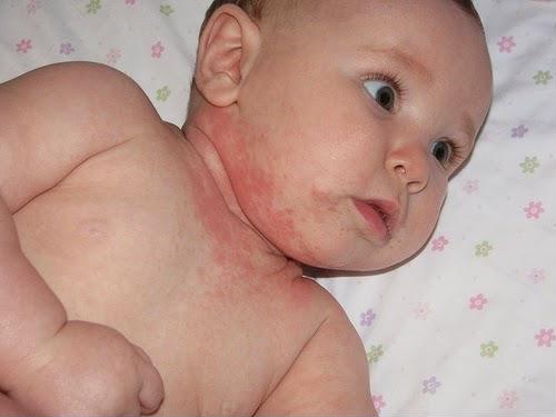 Trẻ sơ sinh bị mẩn đỏ ở cổ có thể do hăm da vì ẩm ướt. Ảnh minh họa: Internet