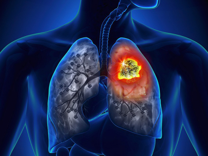 Ung thư phổi được biết tới là loại ung thư phổ biến và nghiêm trọng nhất