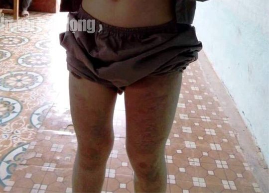 Lưng và hai đùi của bé trai N.C.D bị bạo hành thâm tím