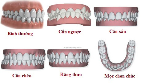  Các trường hợp răng lệch, khớp cắn sai được chỉ định niềng răng