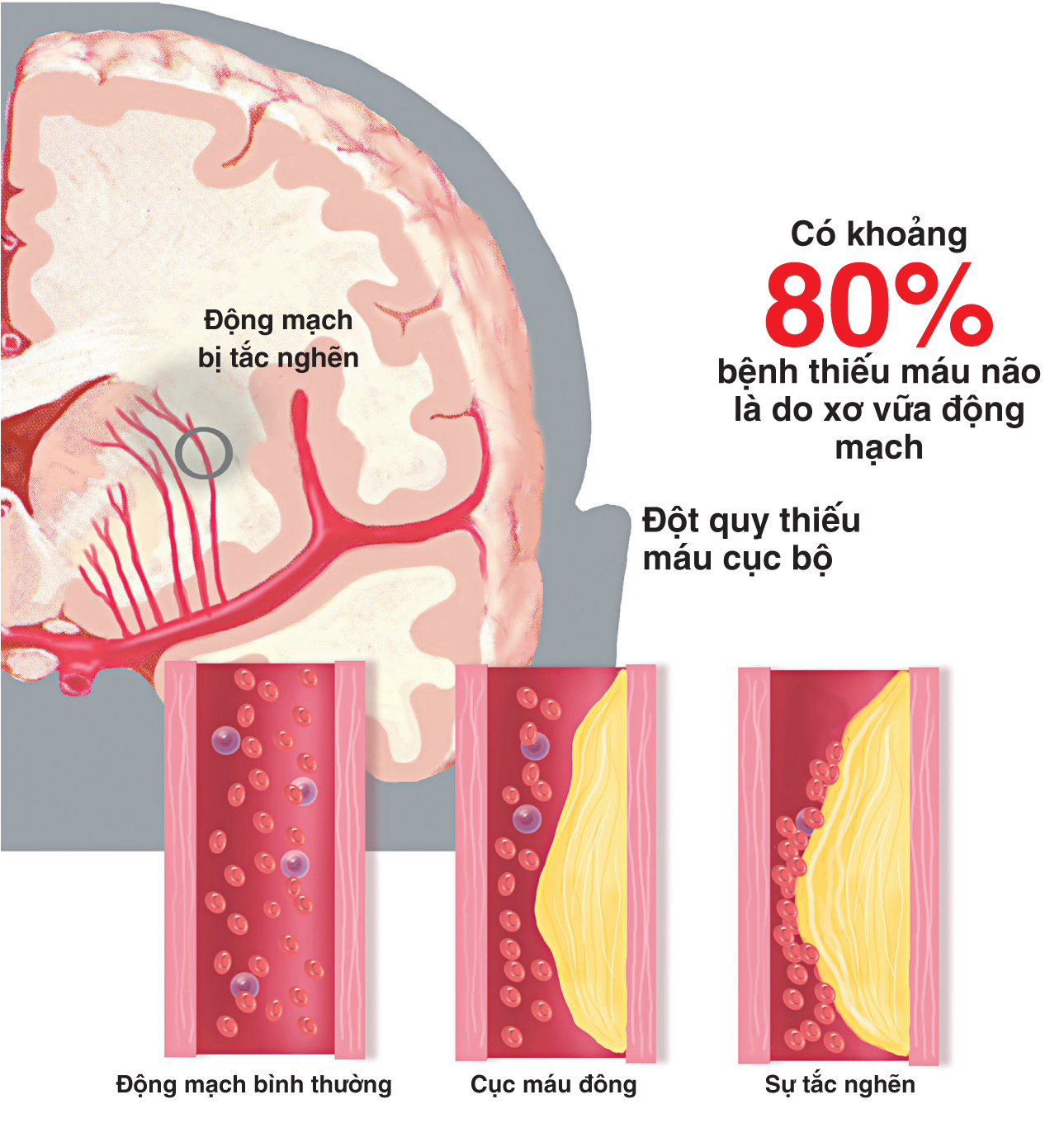  Thiểu năng tuần hoàn não là căn bệnh nguy hiểm - Ảnh minh họa: Internet