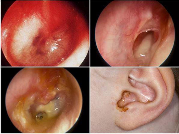  Hình ảnh ống tai trẻ bị viêm tai giữa chảy mủ - Ảnh minh họa: Internet