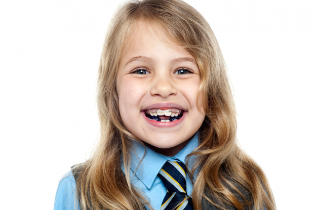  Niềng răng sai cách với trẻ em có thể gây rụng răng, lệch xương hàm