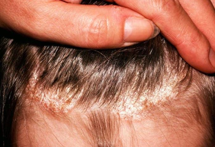  Các mảng da trở nên thô ráp, gập ghềnh, thậm chí có mảng dày là dấu hiệu rõ ràng của vảy nến da đầu - Ảnh minh họa: Internet