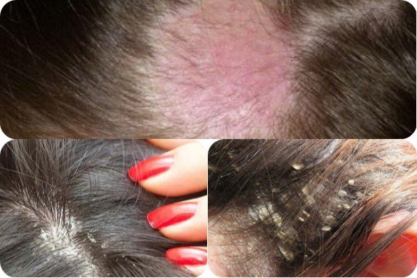  Vảy nến da đầu có thể gây nhiễm trùng với những dấu hiệu kèm theo là viêm sưng, bị sưng hạch bạch huyết - Ảnh minh họa: Internet