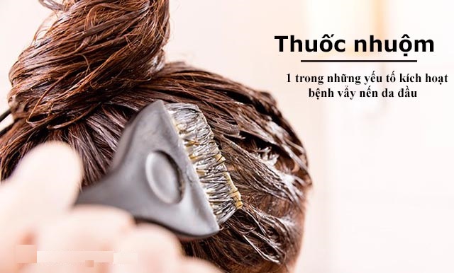  Nhuộm tóc thường xuyên cũng là một trong những nguyên nhân gây nên chứng vảy nến da đầu - Ảnh minh họa: Internet