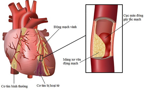  Nhồi máu cơ tim là một bệnh lý tim mạch nguy hiểm.