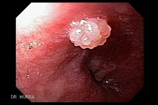  Hình ảnh u nhú do nhiễm virus HPV ở thực quản trên nội soi