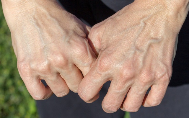  Những người có lá gan kém thường nổi gân xanh trên mu bàn tay