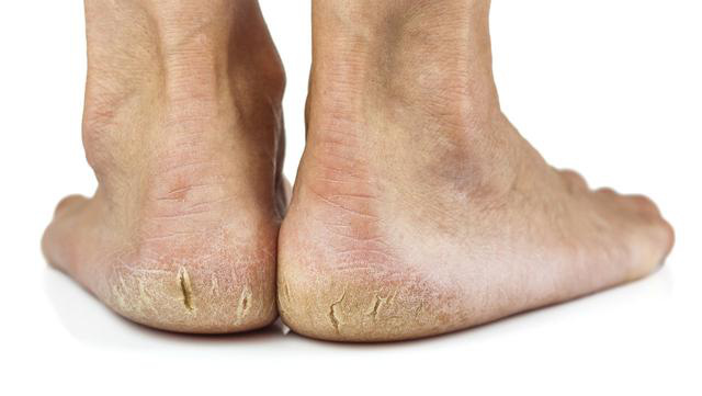  Có 4 nguyên nhân gây nên tình trạng gót chân bị nứt nẻ, khô ráp