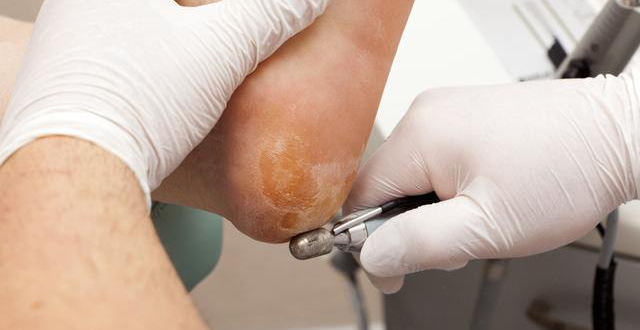  Việc cắt các lớp sừng ở gót chân không loại bỏ triệt để được lại còn gây đau đớn và mất thẩm mỹ.