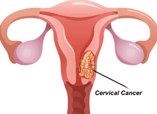  Ung thư cổ tử cung là loại ung thư phổ biến ở nữ giới.