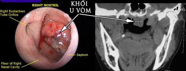  Hình ảnh nội soi và cắt lớp vi tính khối u vòm họng.