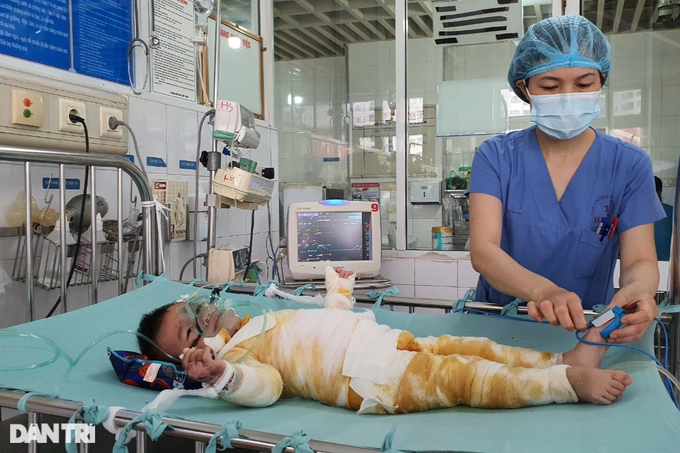  Bị bỏng nước sôi đến 66% cơ thể, nhiều nơi bỏng sâu, sau hơn 1 tuần cứu chữa tích cực, tính mạng bé 20 tháng tuổi vẫn đang hết sức nguy kịch.