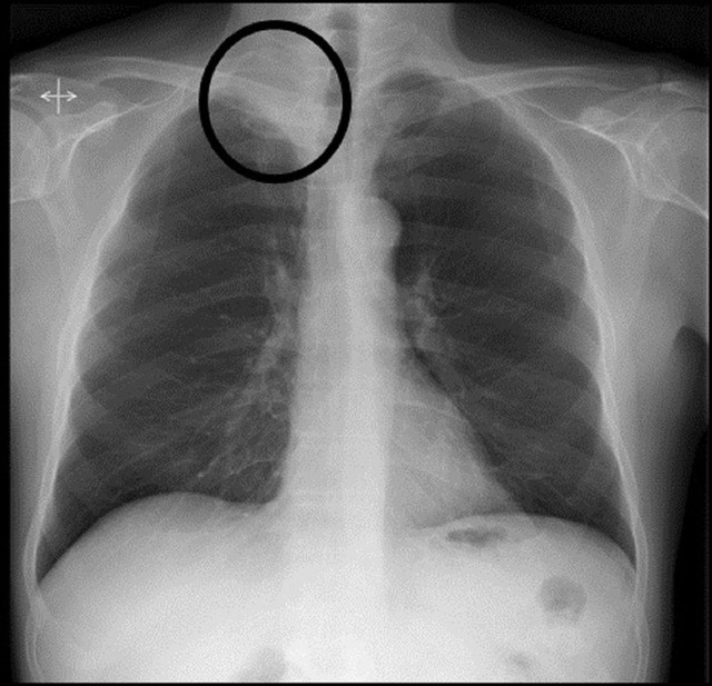  Hình ảnh hội chứng Pancoast - một dạng ung thư phổi (Ảnh: BMJ Journals)