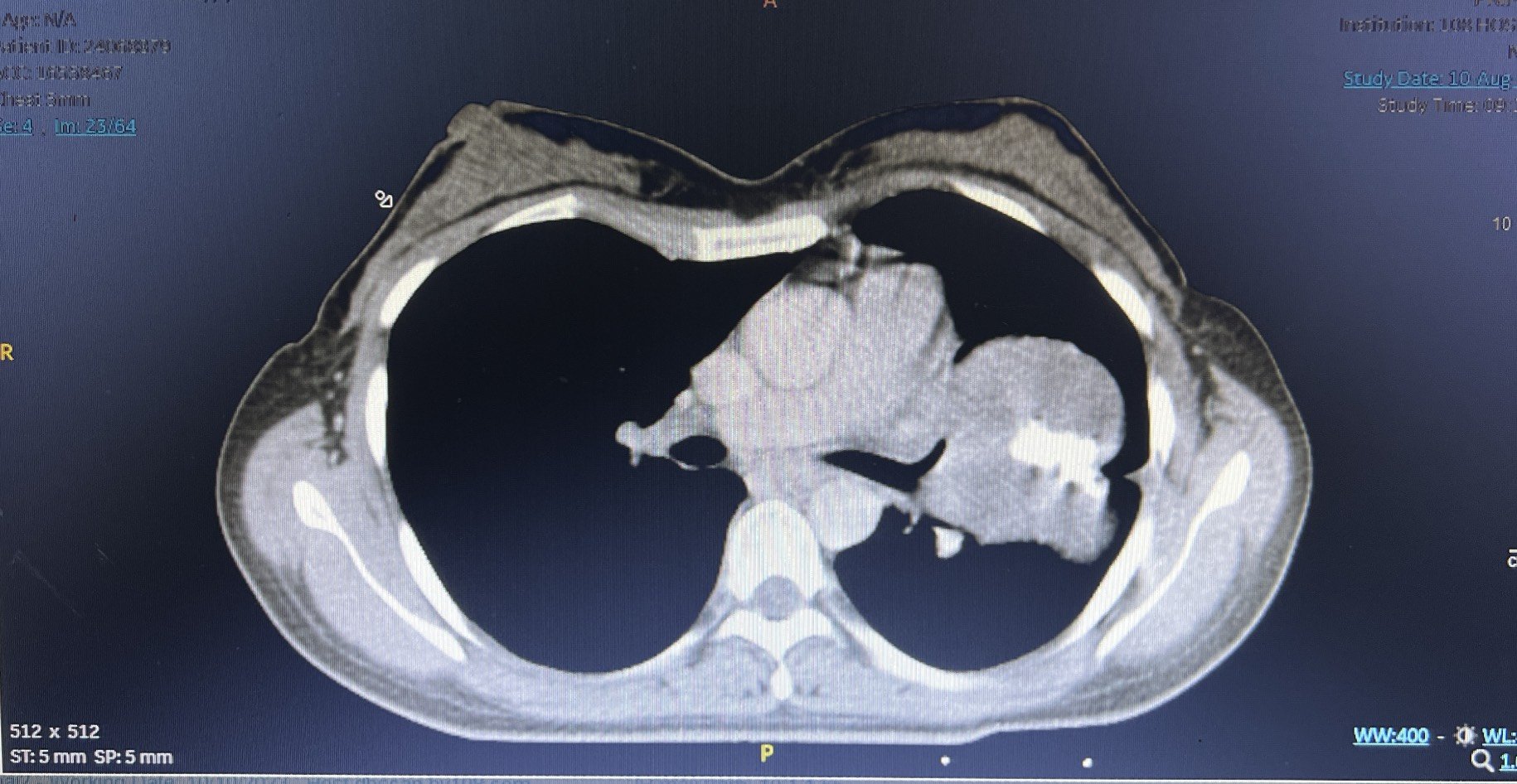  Chụp CT scan ngực cho thấy khối tổn thương có kích thước lớn 8x10cm.