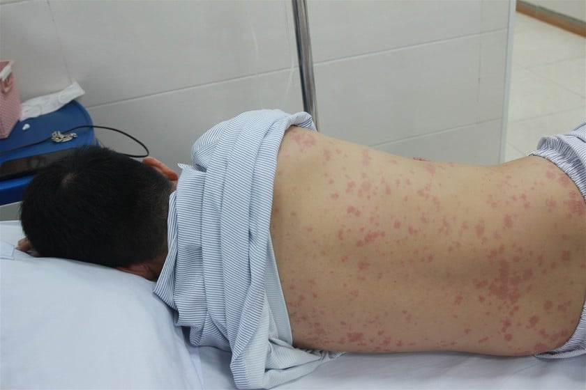  Tình trạng nổi ban toàn thân ở bệnh nhân nhiễm liên cầu lợn - Ảnh: Báo Pháp luật Việt Nam