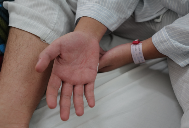  Bệnh nhân sốt xuất huyết với bàn tay đầy ban đỏ, điều trị tại bệnh viện Bạch Mai. Ảnh: Ngọc Thành