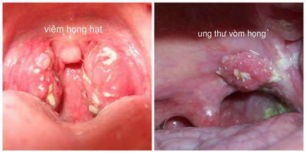  Ung thư vòm họng thường có triệu chứng ban đầu tương đồng với viêm họng (Ảnh: Vinmec)