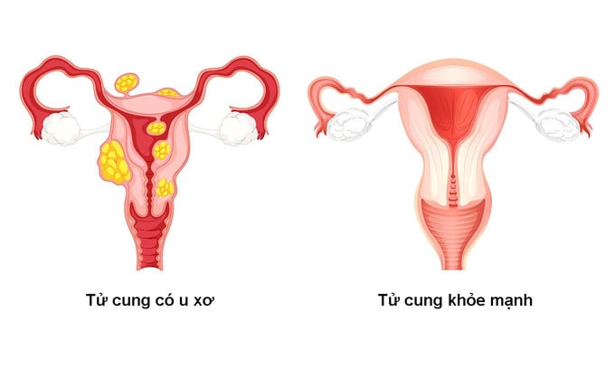  U xơ tử cung là bệnh lý thường gặp ở phụ nữ