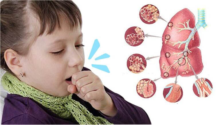  Ho gà là một bệnh truyền nhiễm cấp tính có khả năng lây lan nhanh qua đường hô hấp, bệnh có thể xảy ra ở mọi lứa tuổi, nhưng thường gặp ở trẻ em (Ảnh minh họa)
