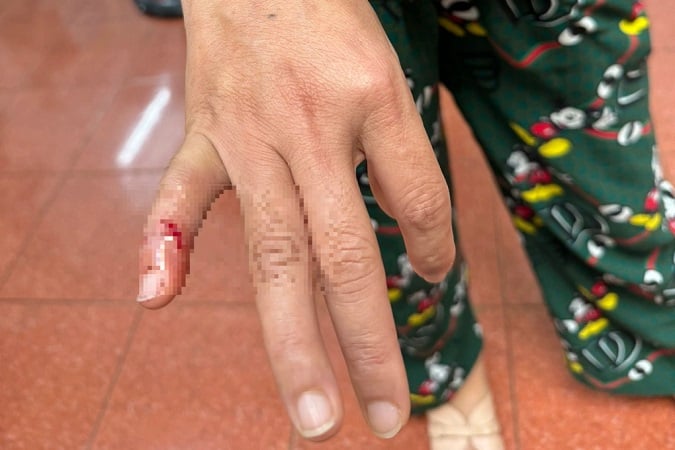  Chị N.T.N. (44 tuổi) bất ngờ bị một con chó màu đen xông đến cắn vào tay gây chảy máu. Ảnh: Báo Dân Trí. 