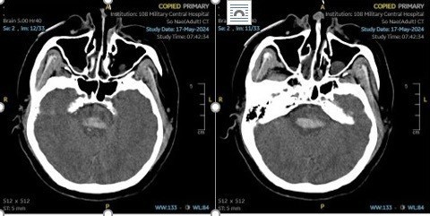  Tổn thương thân não trên phim chụp - Ảnh BVCC