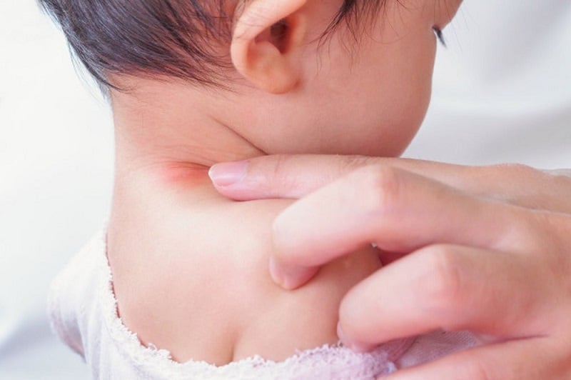 Hăm cổ là tình trạng khá phổ biến ở trẻ sơ sinh, đặc biệt là vào mùa nắng nóng