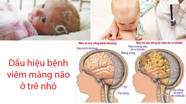  Những dấu hiệu nhận biết bệnh viêm màng não ở trẻ (Ảnh minh họa)