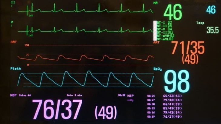   Nhịp tim chậm trên máy theo dõi - Ảnh minh họa