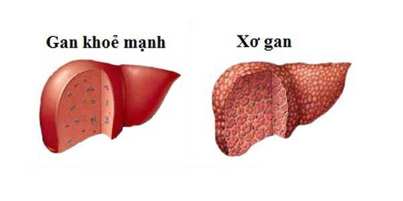  Hình ảnh gan khỏe mạnh và xơ gan