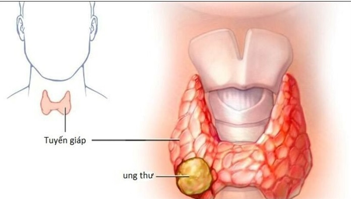  Ung thư tuyến giáp có thể được chữa khỏi nếu được phát hiện sớm và điều trị đúng cách.