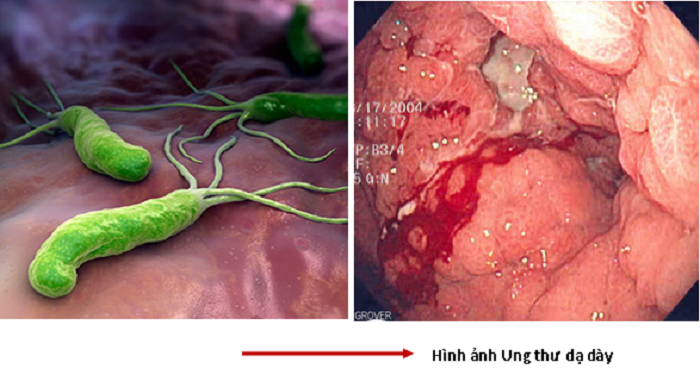  Vi khuẩn HP (Helicobacter pylori) được coi là một nguyên nhân gây ung thư dạ dày.