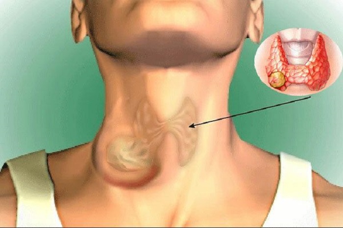  Khi có triệu chứng nghi ngờ ung thư tuyến giáp cần khám sớm để được chẩn đoán chính xác, điều trị đúng cách và kịp thời.