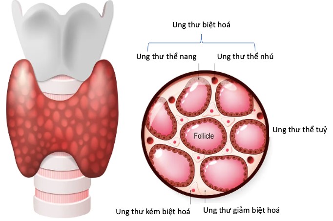  Các thể ung thư tuyến giáp.