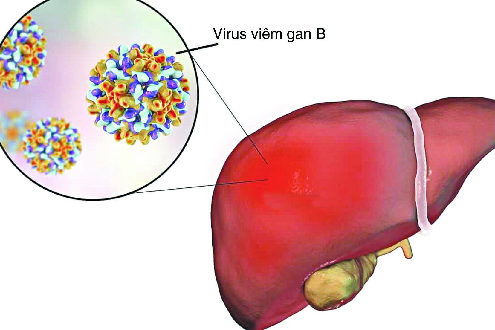  Bệnh nhân mắc viêm gan B cần tuân thủ chỉ định của bác sĩ.