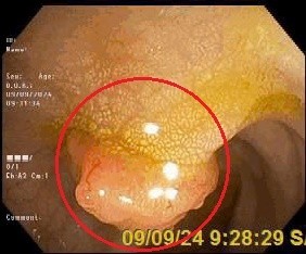Hình ảnh polyp đại tràng của chị N. (vùng khoanh tròn màu đỏ) - Ảnh BVCC