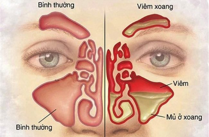  Hình ảnh về viêm xoang.