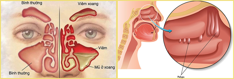  So sảnh giữa viêm xoang và poly mũi.