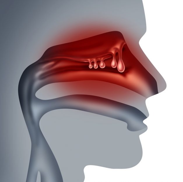  Các polyp mũi được hình thành từ lớp niêm mạc mũi bị viêm mạn tính.