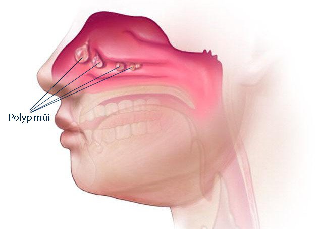  Hình ảnh về poly mũi