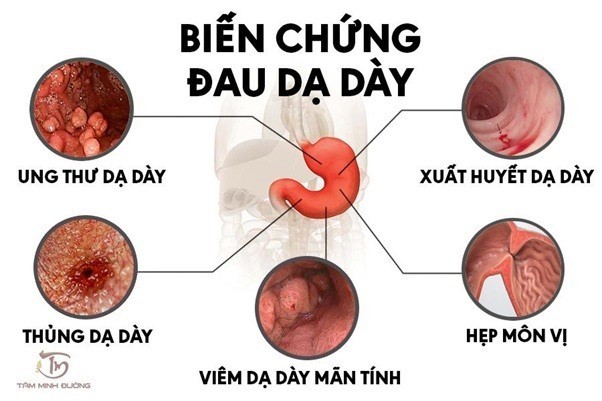   Các bệnh thường gặp về dạ dày ai cũng nên biết.